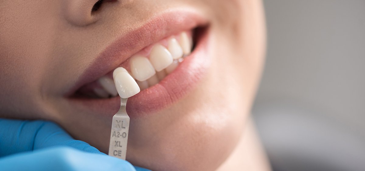 How Much Does It Cost For Tooth Filling North York Dental Clinic