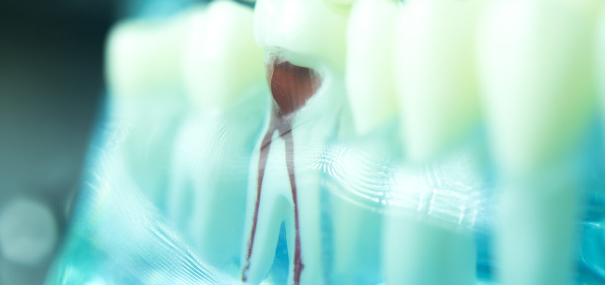 How Much Does Treatment for Root Canal Cost?