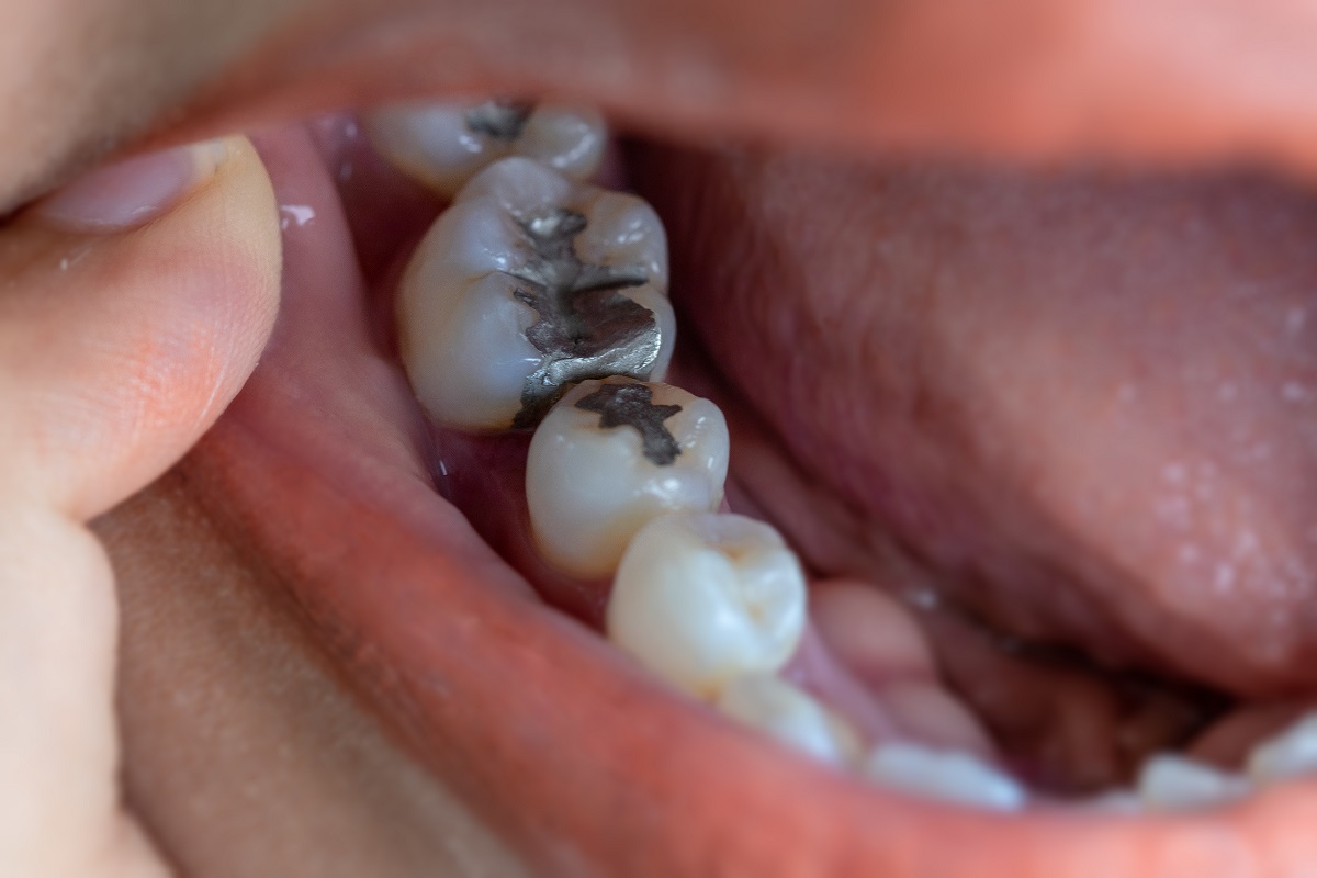 cavity side of molar