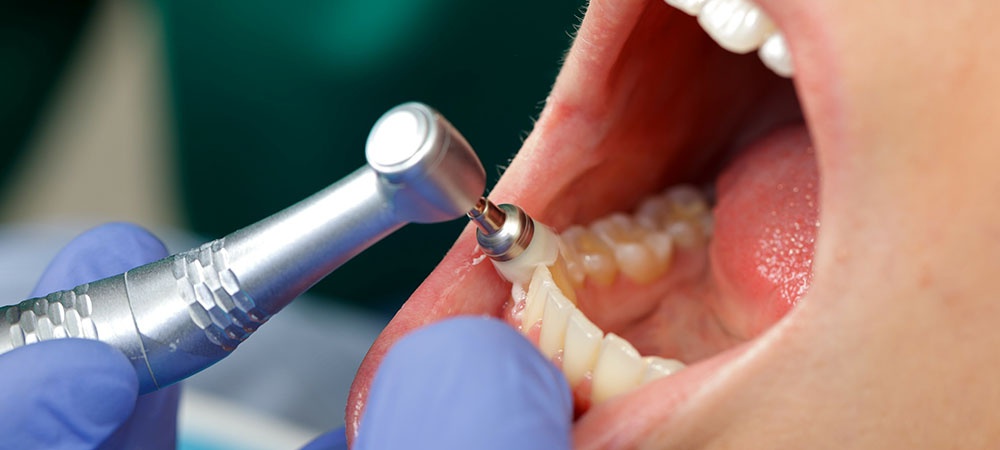 How much is Teeth Cleaning Without Insurance?