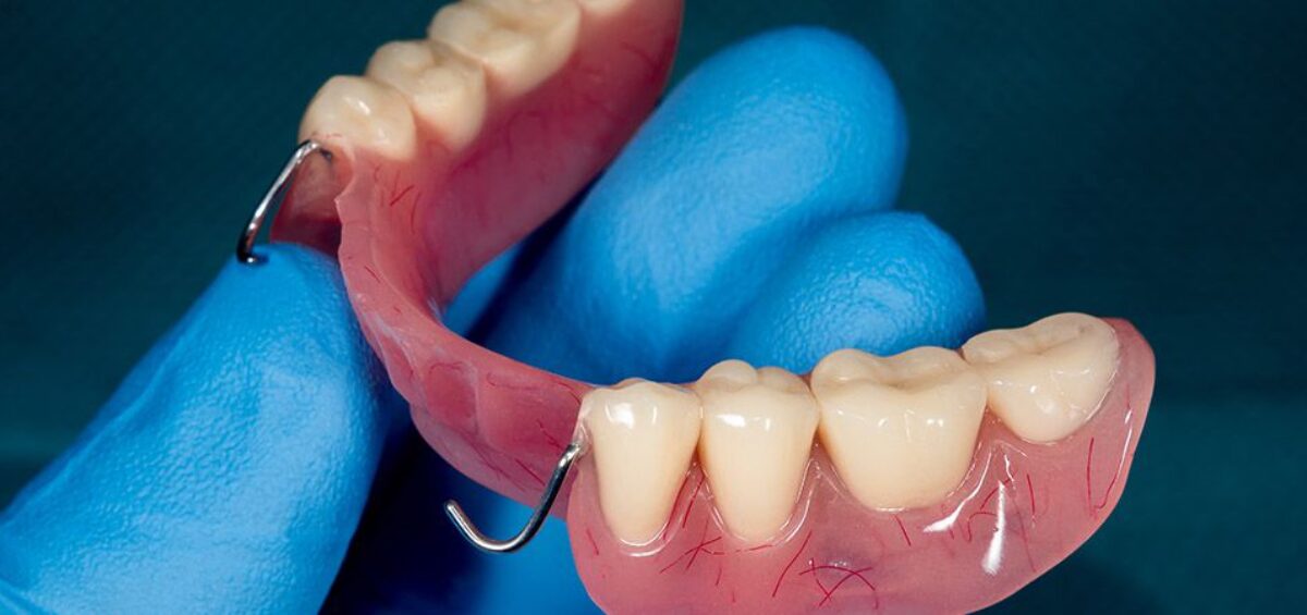 dental implants and partial denture