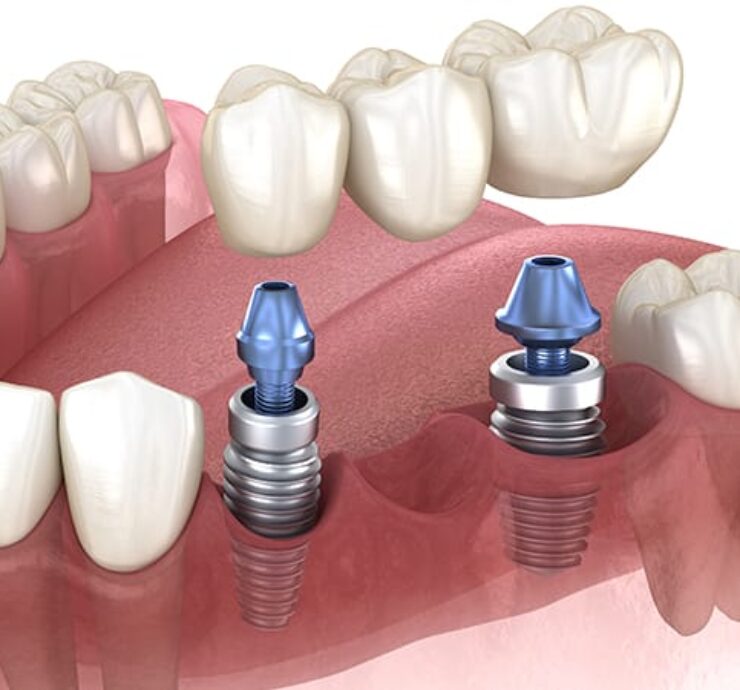 dental bridge cost